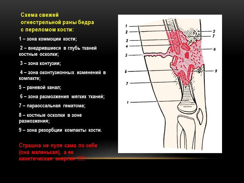 Схема свежей огнестрельной раны бедра с переломом кости:  1 – зона коммоции кости;